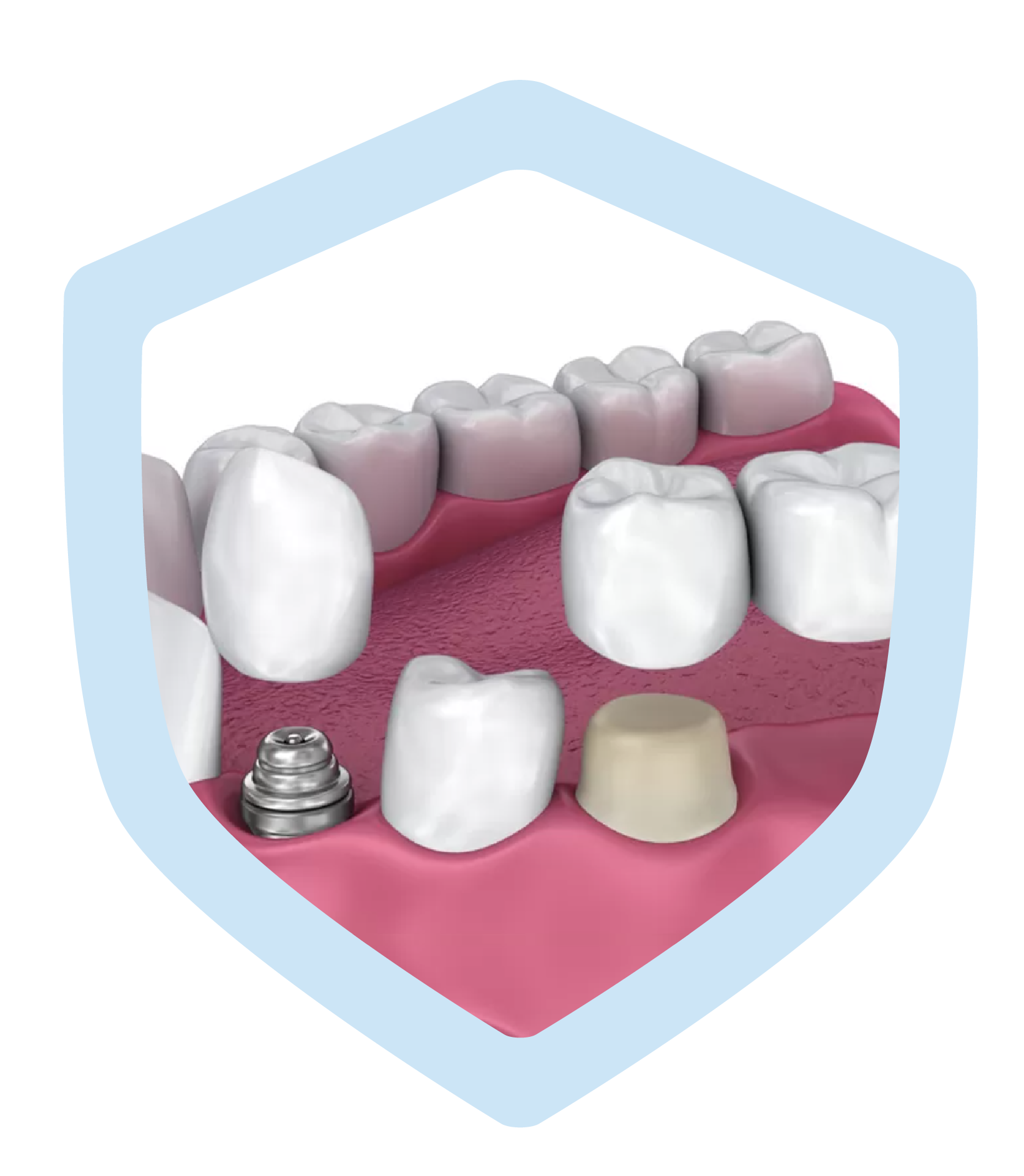 Dental restorations Oral Nova Dent