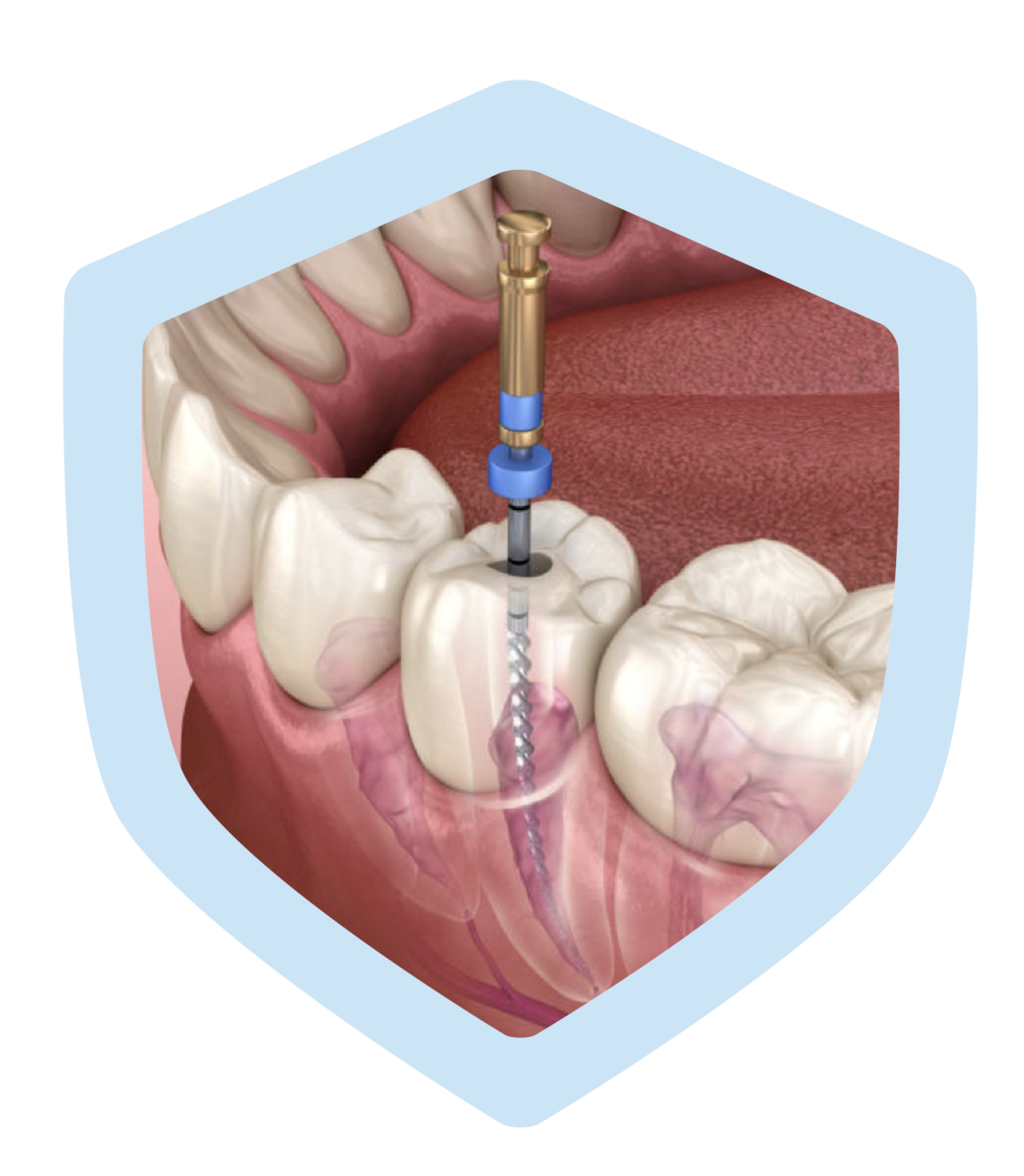 Root canals Oral Nova Dent